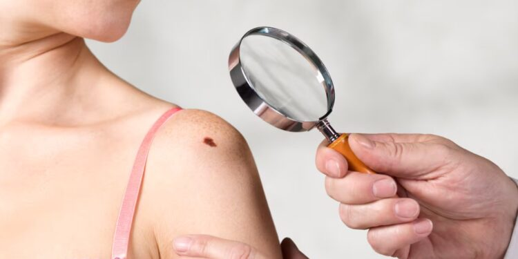 Melanoma cutáneo en aumento: el 80% de los casos está vinculado a la exposición solar, advierte la OMS